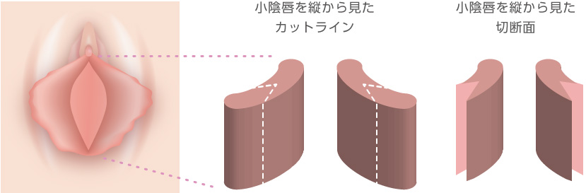 小陰唇を縦から見たカットライン・切断面