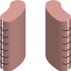 小陰唇外縫い法縫合イメージ