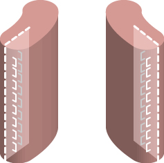 小陰唇二重中縫い法