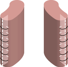 小陰唇中縫い法縫合イメージ