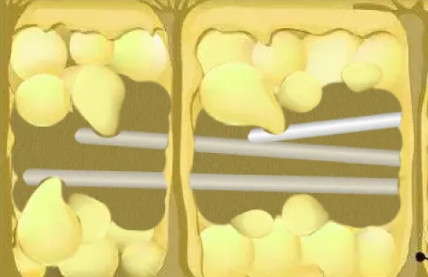 シリンジ脂肪吸引イメージ