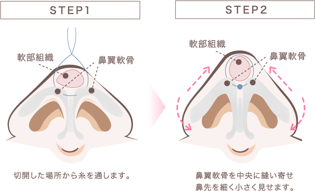鼻尖縮小施術方法