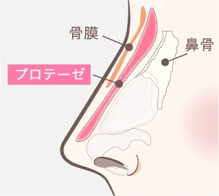 カスタマイズプロテーゼイメージ