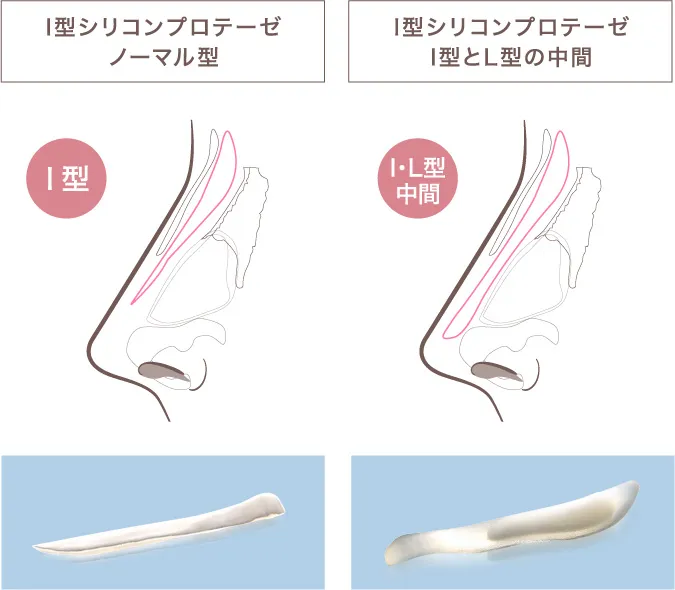 I型とI型・L型の中間プロテーゼイメージ
