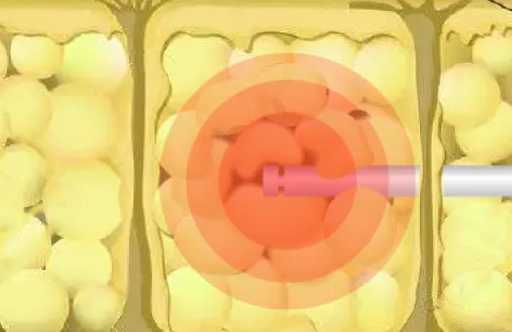 ベーザー脂肪吸引イメージ