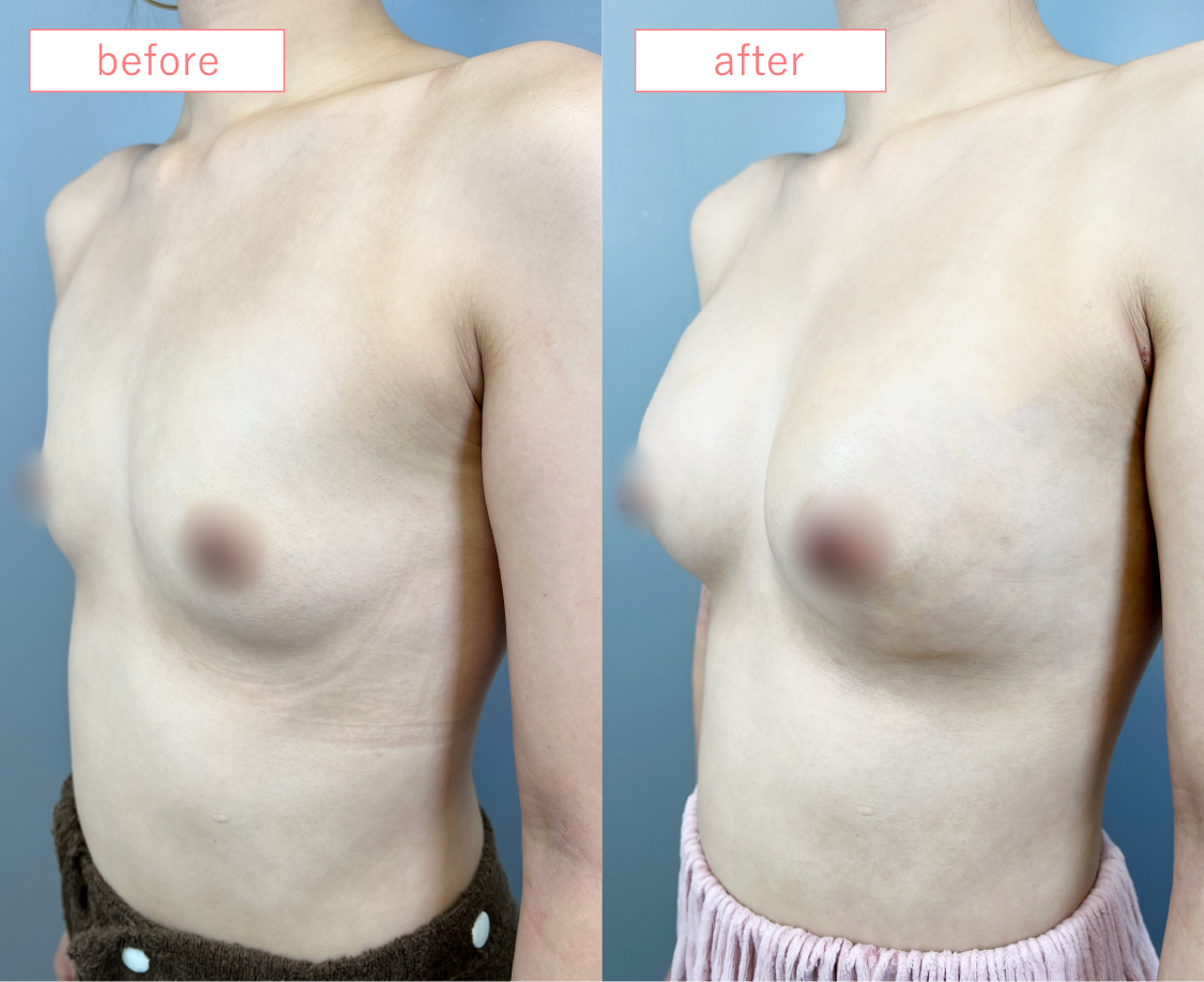 まりコロ企画整形無料モニター02