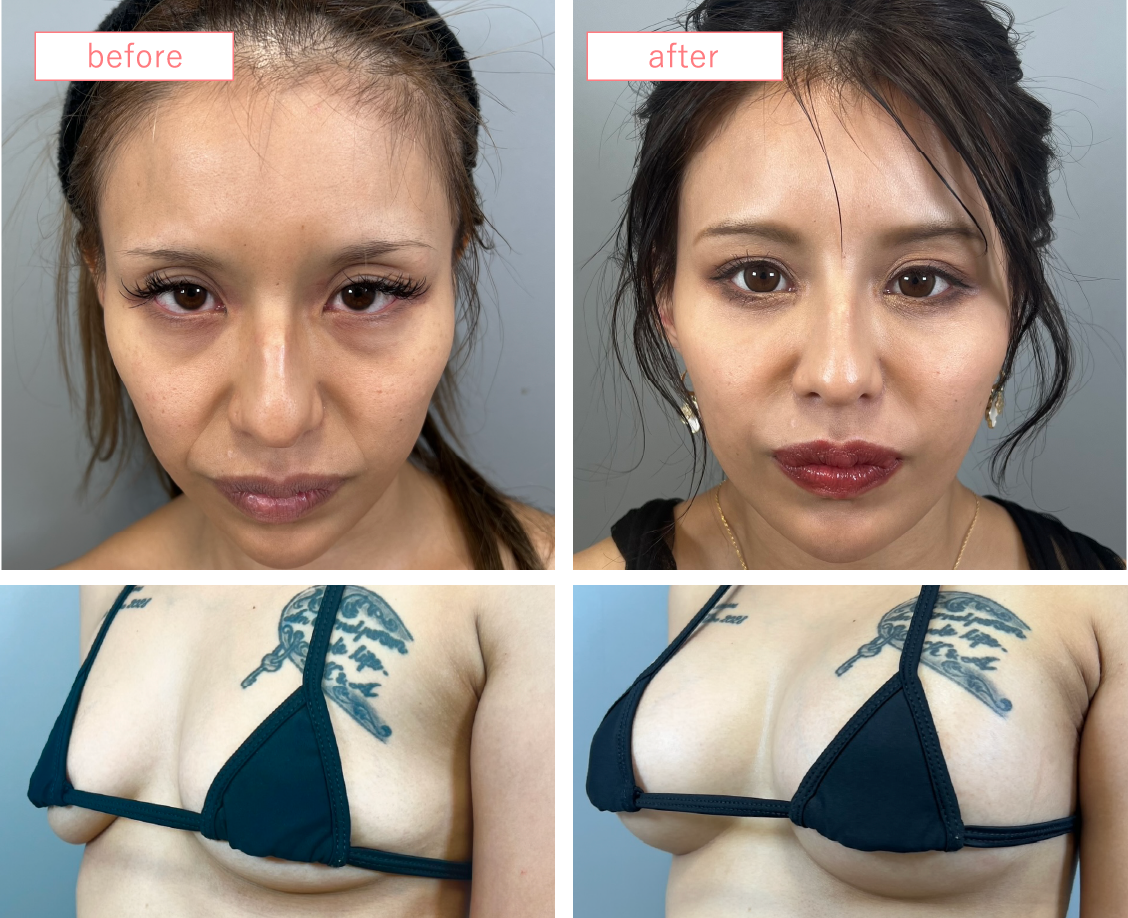 まりコロ企画整形無料モニター03