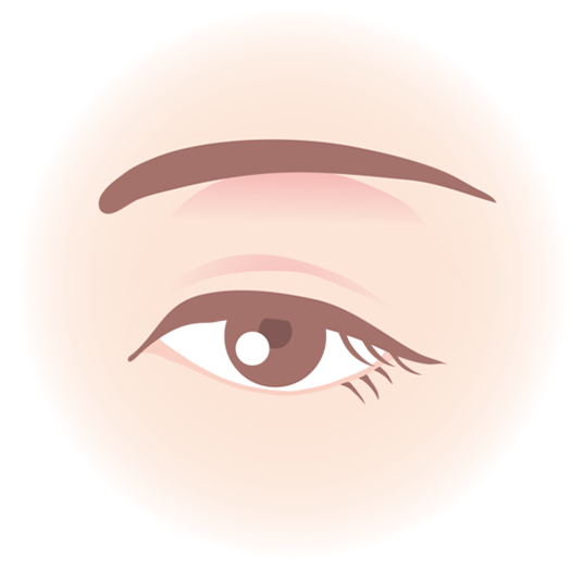 イメージ:まぶたの伸びを修正する前の状態