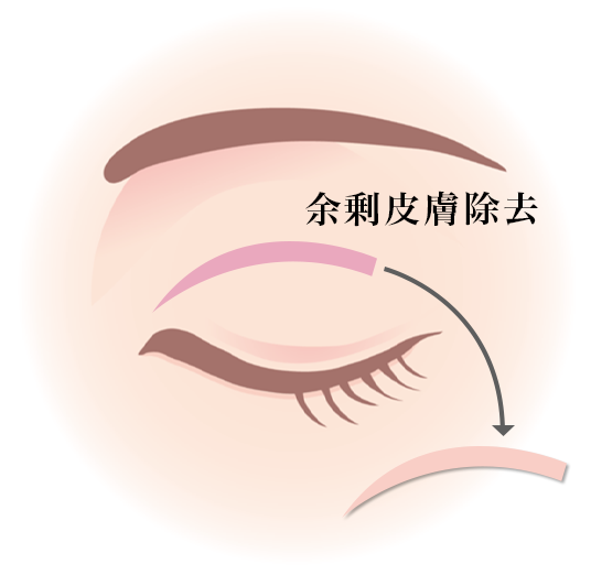 イメージ:まぶたの余剰な皮膚を除去