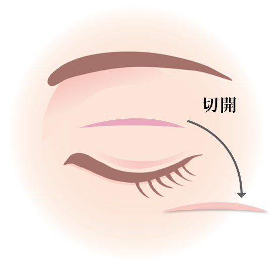 02,まぶた切開の説明画像