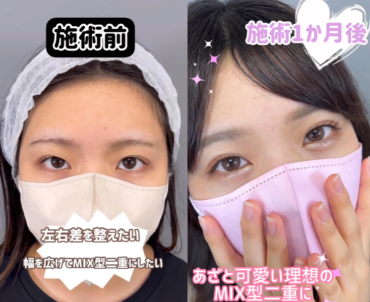 MIX型二重の似合うお顔