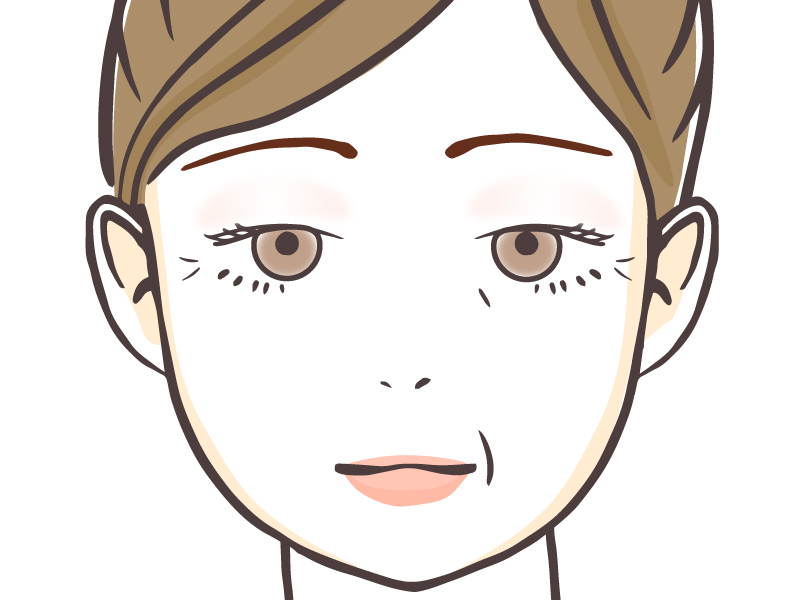 まぶたに脂肪がついた状態イラスト