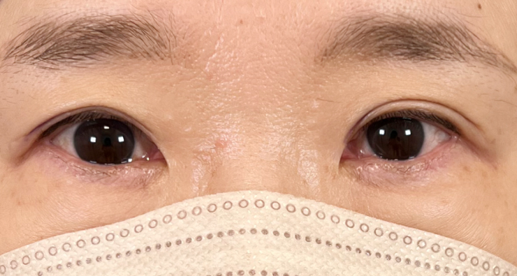 二重埋没法10年後