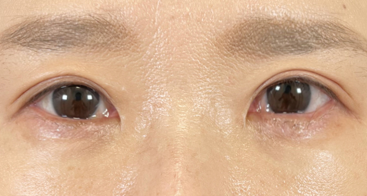 崩れた埋没法を修正した画像