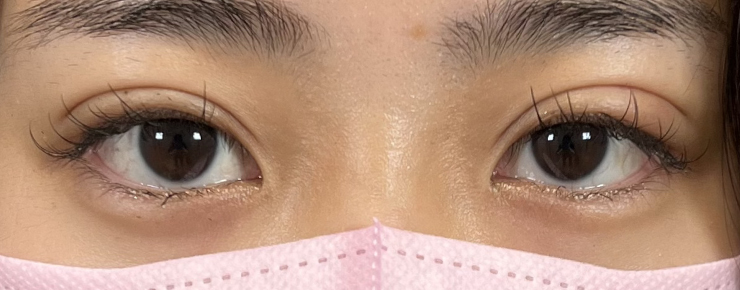 埋没法・腫れ画像