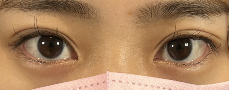 埋没法・腫れが引いた画像