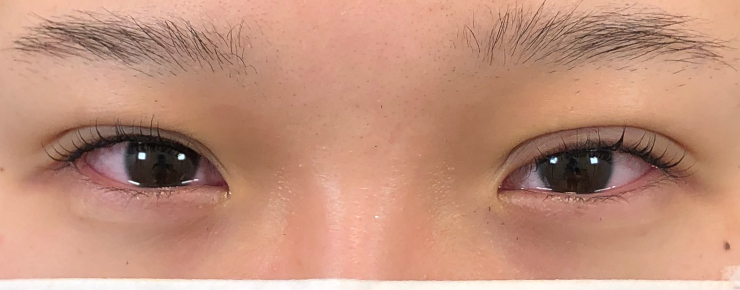 埋没法・腫れ画像