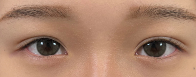 埋没法・腫れ他院修正画像