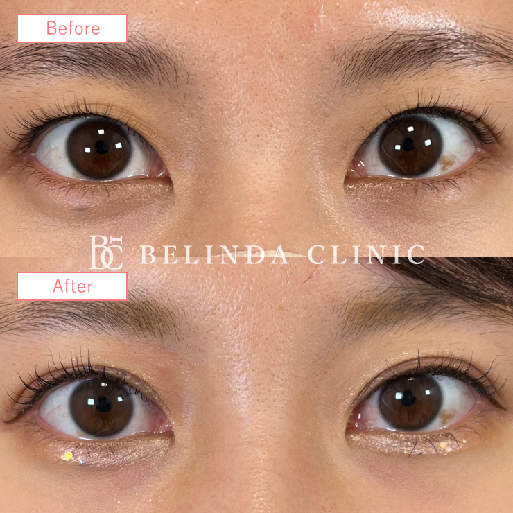 二重埋没法症例 No1097