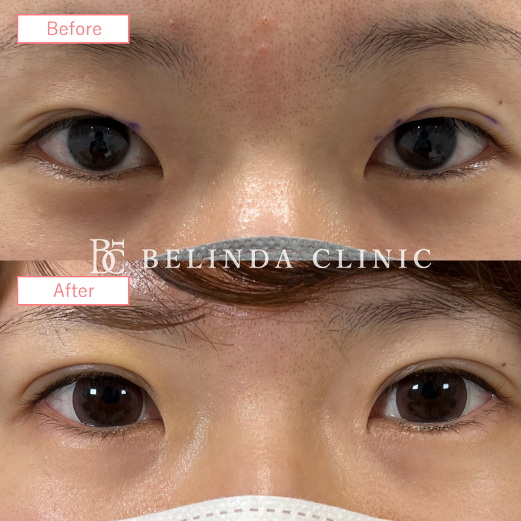 二重埋没法症例 No1743