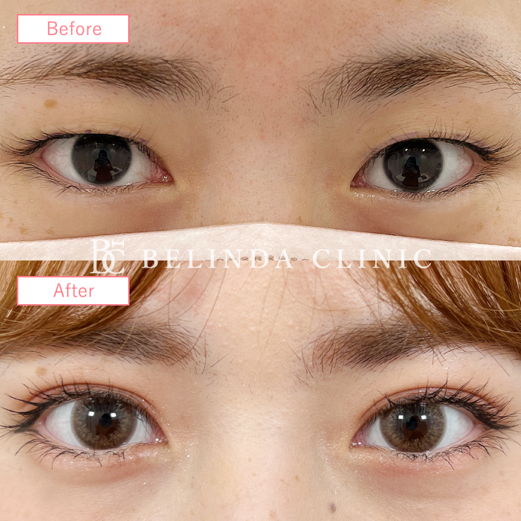 二重埋没法症例No198