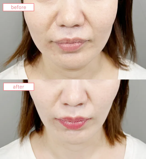 糸リフト症例No20230526-lift-s01