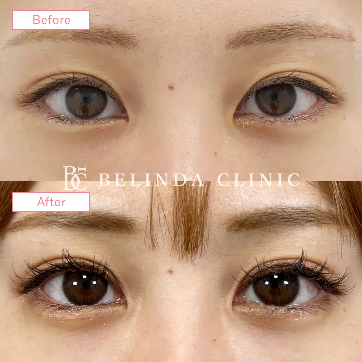 二重埋没法症例No21No