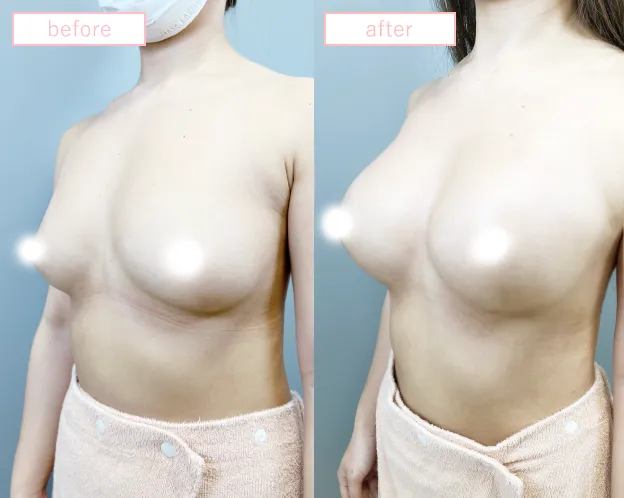 ヒアルロン酸豊胸No2204