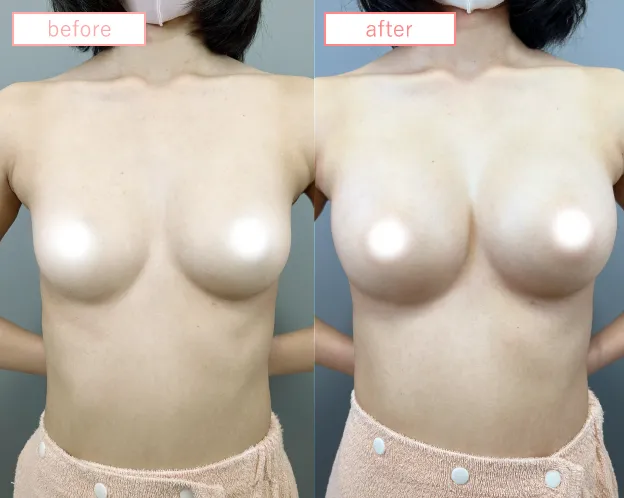 脂肪豊胸症例