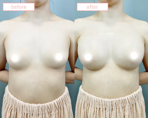 ヒアルロン酸豊胸No2562