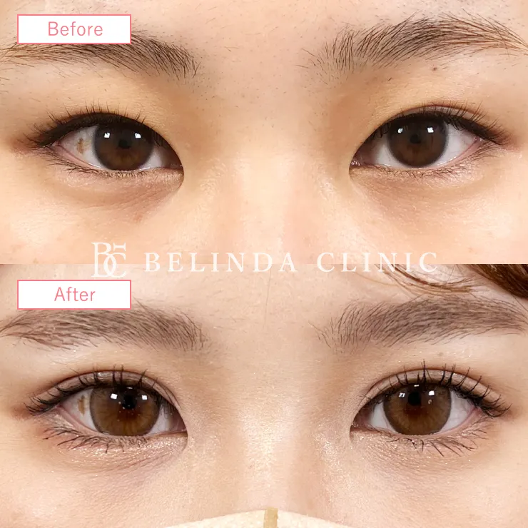 二重埋没法症例No2636