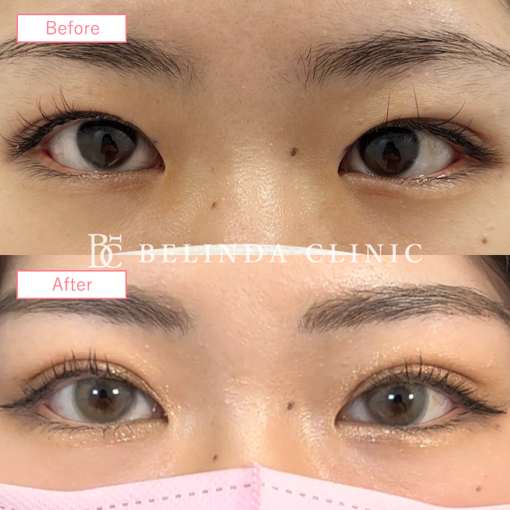 二重埋没法修正ビフォーアフターcase07