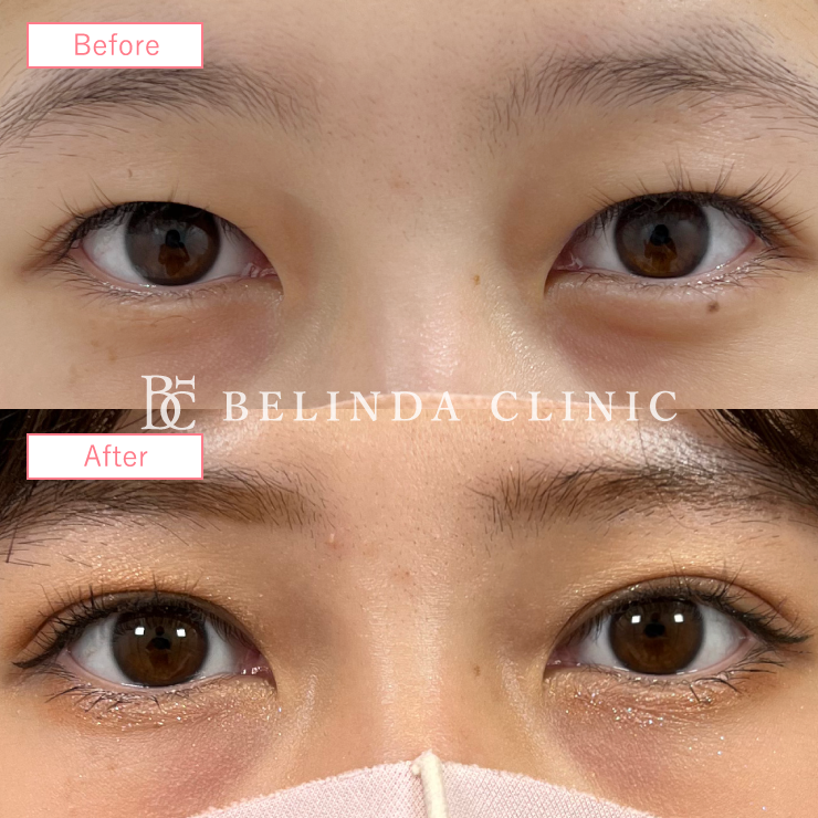 二重埋没法症例No337