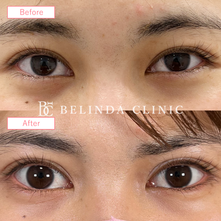 二重埋没法症例No386