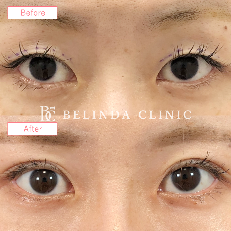 二重埋没法症例No397