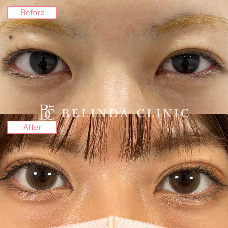 二重埋没法症例No410