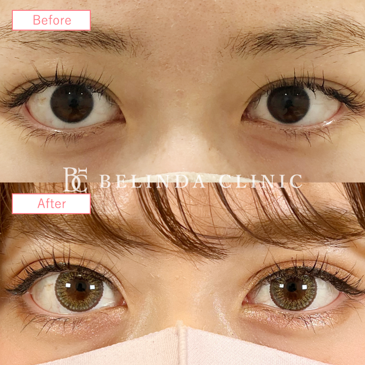 二重埋没法症例No420