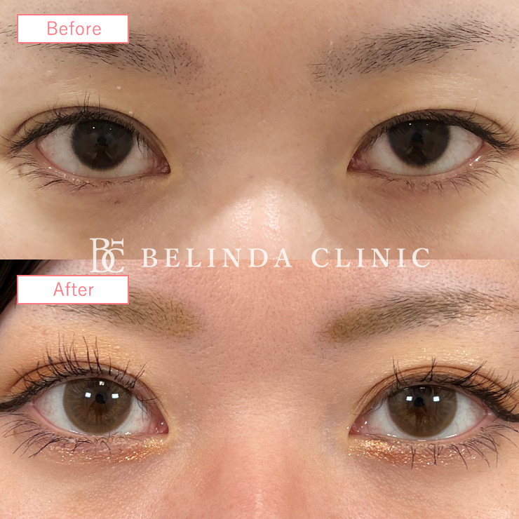 二重埋没法修正ビフォーアフターcase07