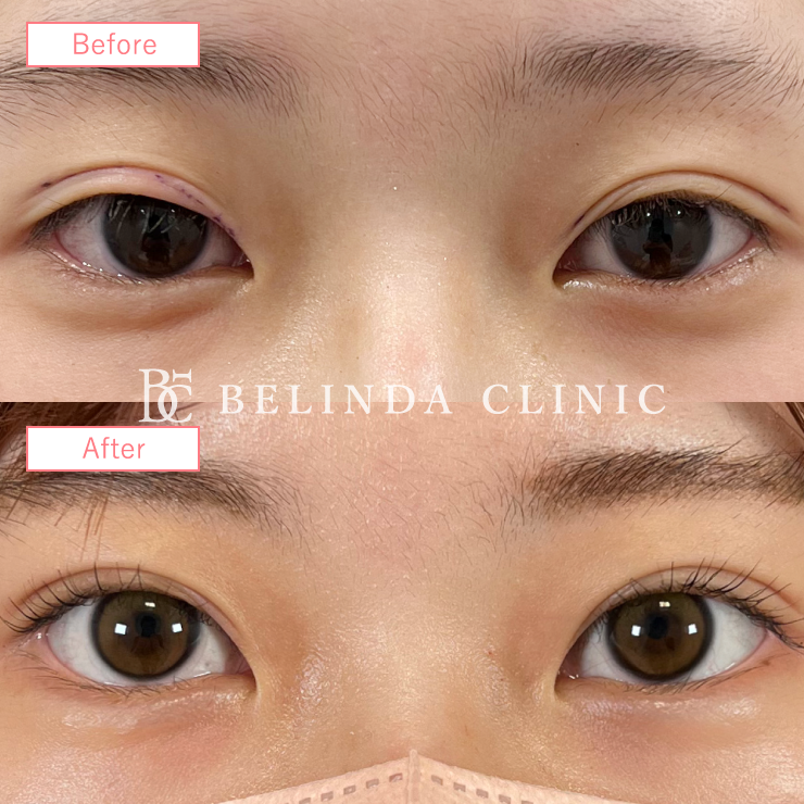 二重埋没法症例No687