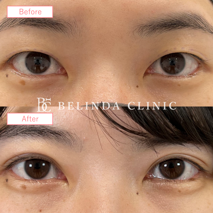 二重埋没法症例No768