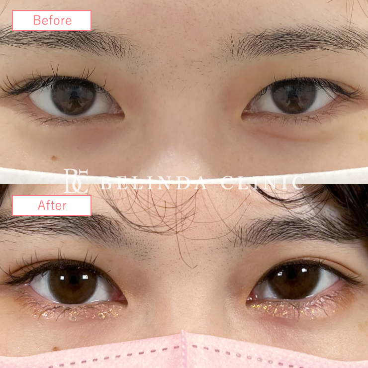 二重埋没法症例No863