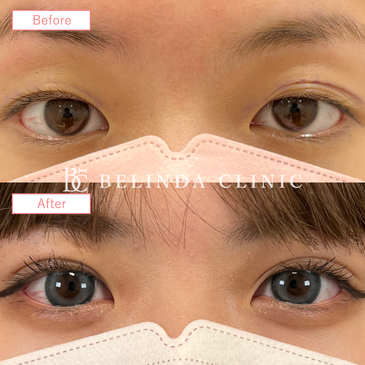 二重埋没法症例No877