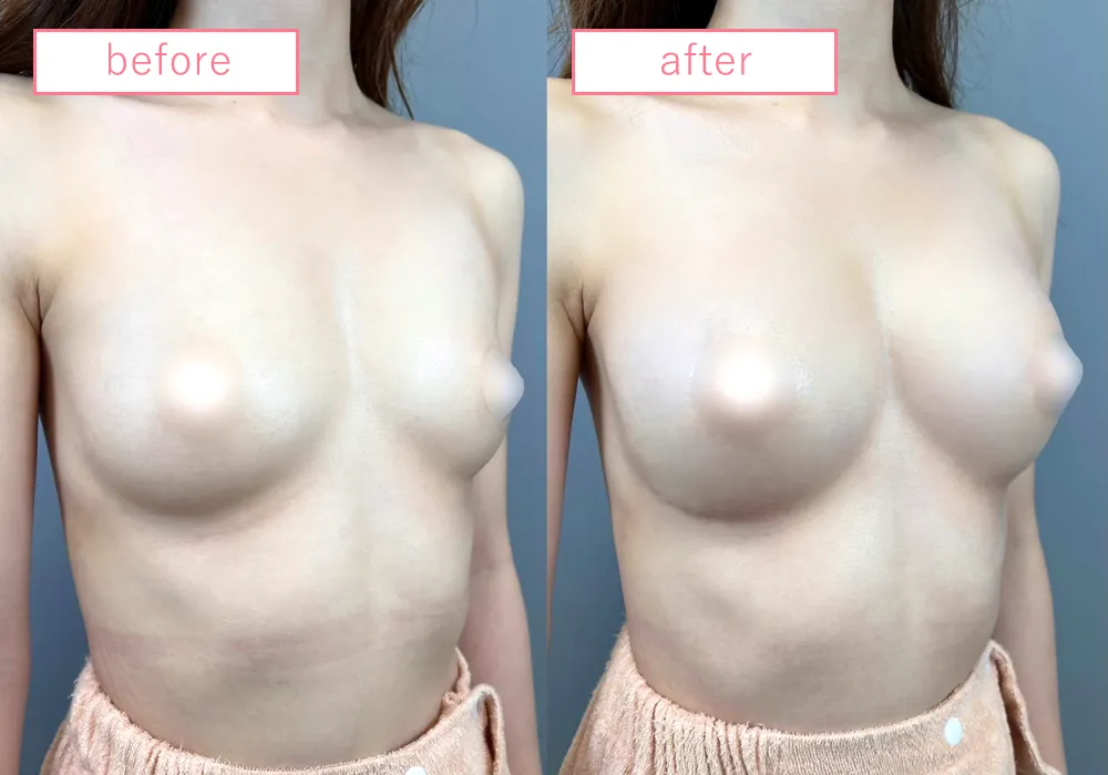 ヒアルロン酸豊胸症例10