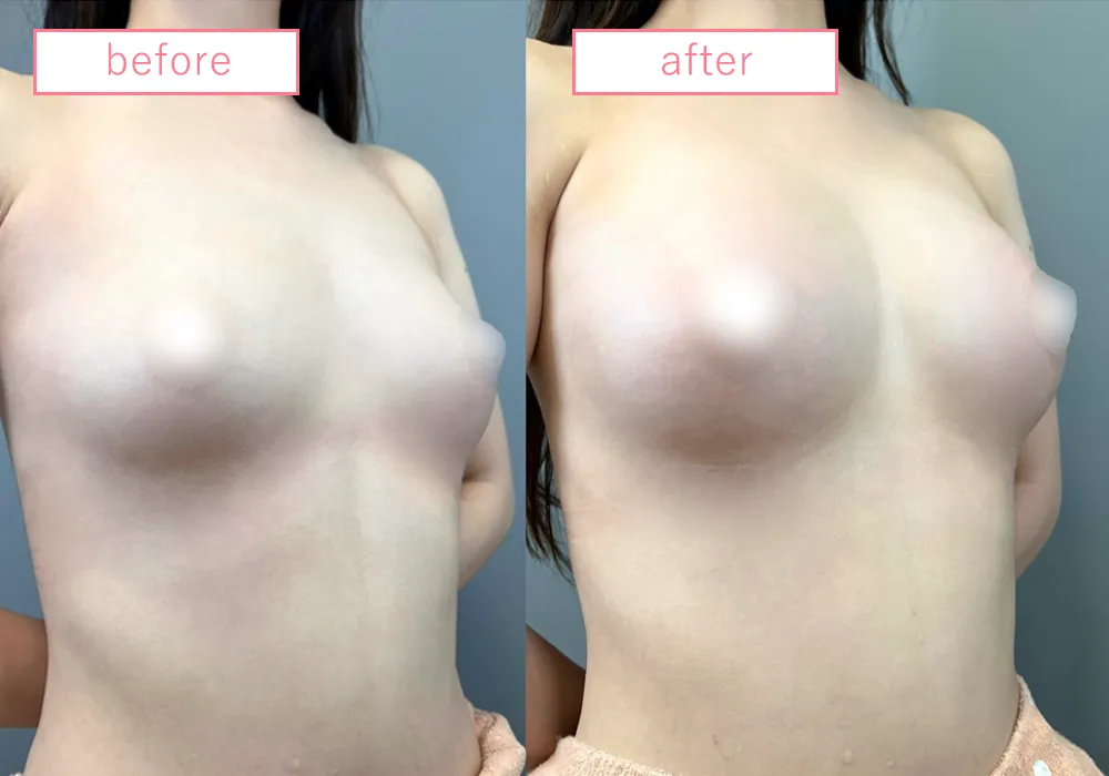 ヒアルロン酸豊胸症例13