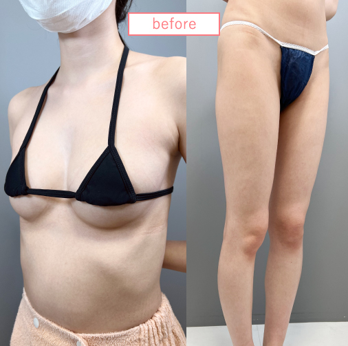 痩せ型の脂肪豊胸ビフォアー