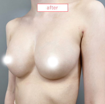 痩せ型の脂肪豊胸アフター