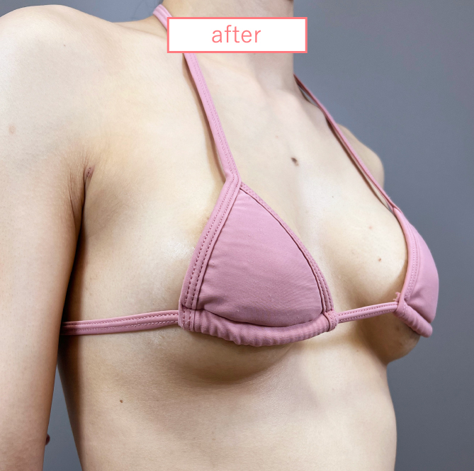 せ型の脂肪豊胸アフター