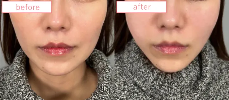 糸リフト症例No20230506-05