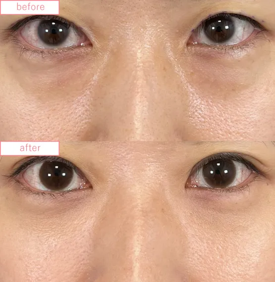 切らないクマ取り症例No.20230507_01