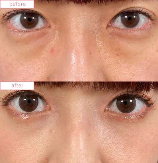 切らないクマ取り症例No.20230507_02